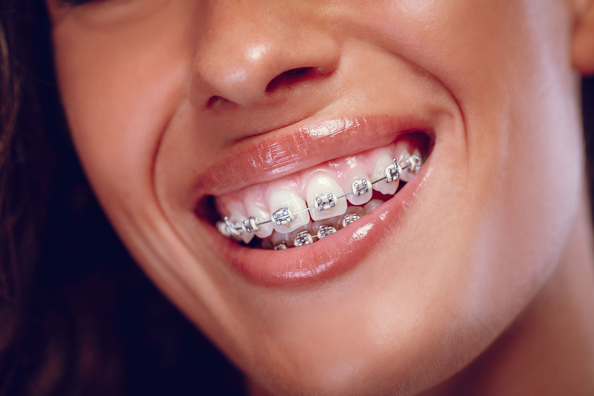 Smile With Braces Too Smile With Braces Too