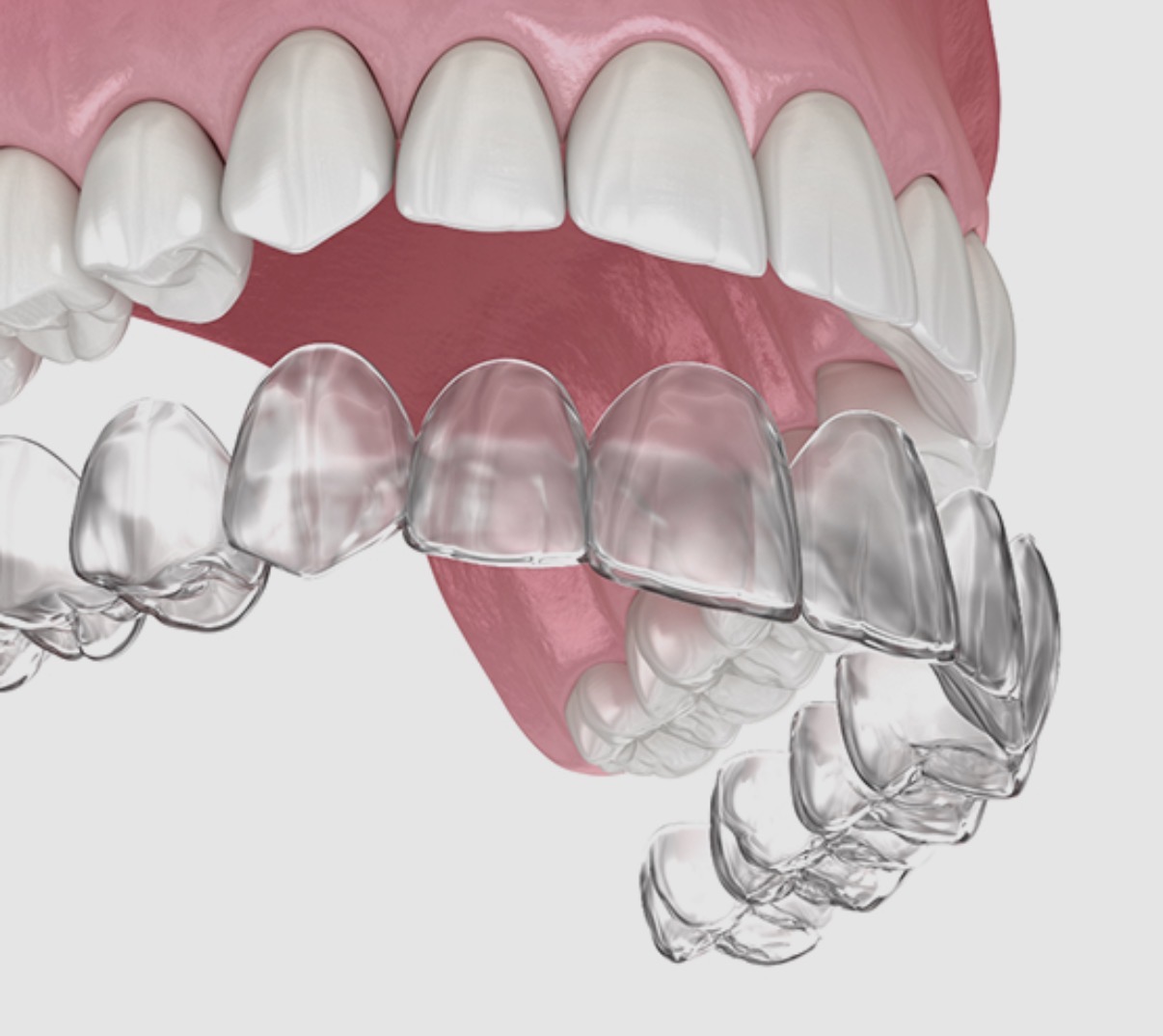 Aligner